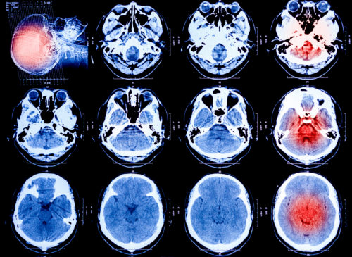 What are the symptoms of a traumatic brain injury - Personal Injury Lawyer Chelsie King Garza