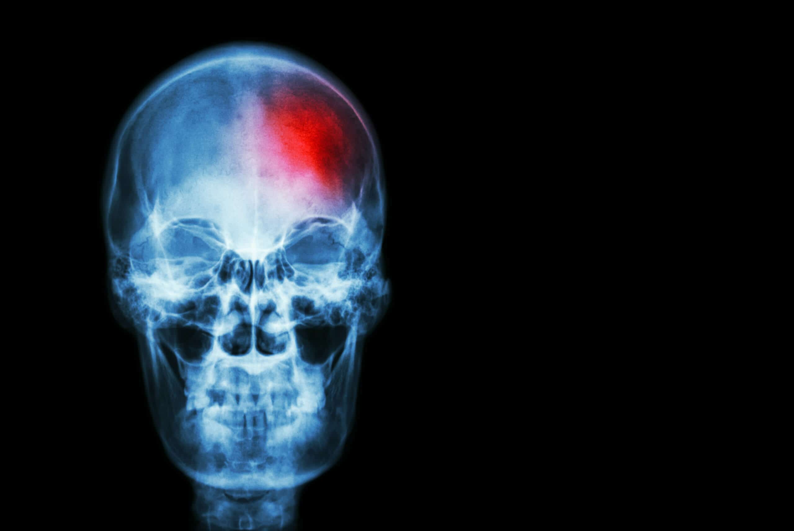 What are the symptoms of a traumatic brain injury - Chelsie King Garza